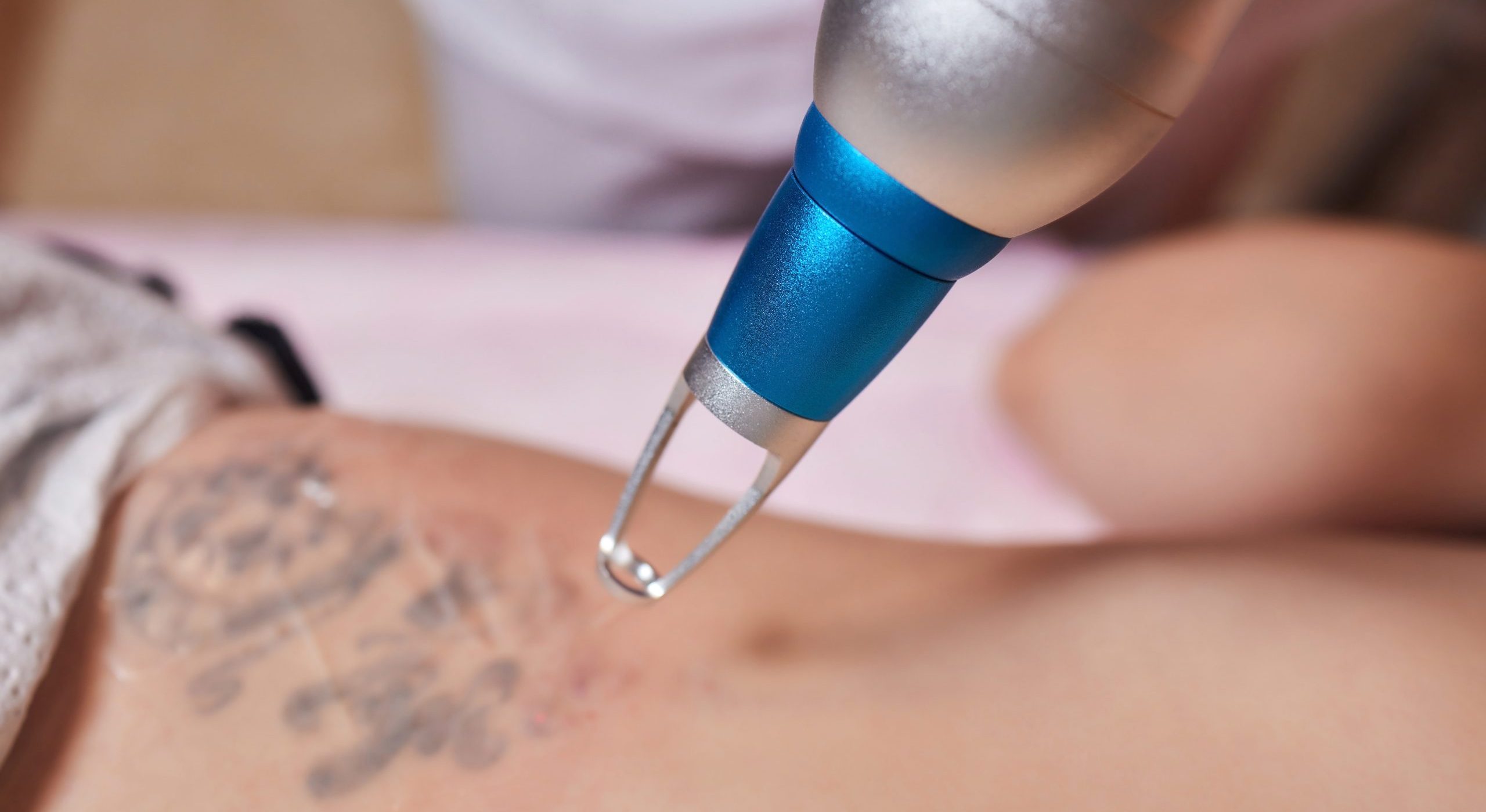 Young woman undergoing laser tattoo removal