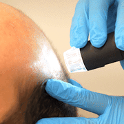 Step wise baldness treatment