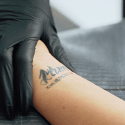 Tattoo Removal