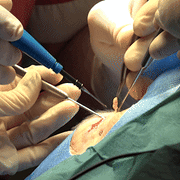 Blephroplasty-eyelid surgery