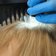 Hair fall tereatments