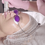 Laser face tigheting