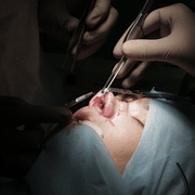 Nose surgery(rhinoplasty)