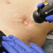 Stretch Marks removal by advanced technique